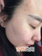 脸上长痘痘是什么原因,脸上长了痘痘是什么原因