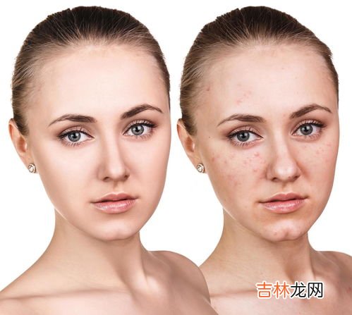 脸上长痘痘是什么原因,脸上长了痘痘是什么原因