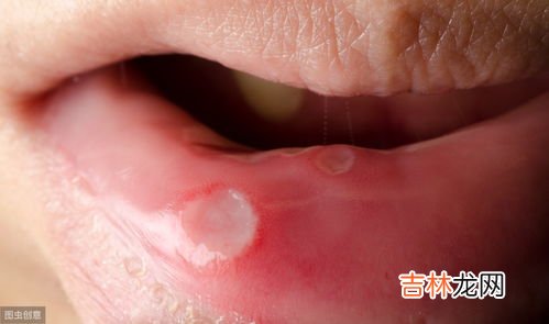 怎么快速治疗口腔溃疡,什么办法治疗口腔溃疡最快速有效啊？拜托了各位 谢谢