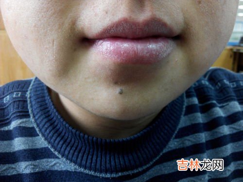 下巴周围有痣代表什么,下巴的痣 有什么意思?