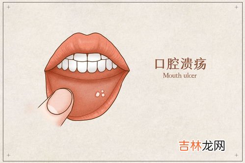 吃什麽能預防口瘡潰瘍,口腔潰瘍吃什麽藥可以預防