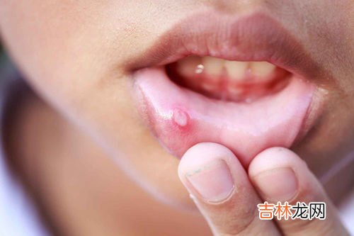 吃什麽能預防口瘡潰瘍,口腔潰瘍吃什麽藥可以預防
