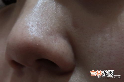 维生素a软膏有激素吗,老中医的肤宝蛇脂软膏含激素吗？