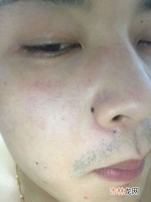 男人下巴有痣代表什么含义,下巴有痣必大富大贵