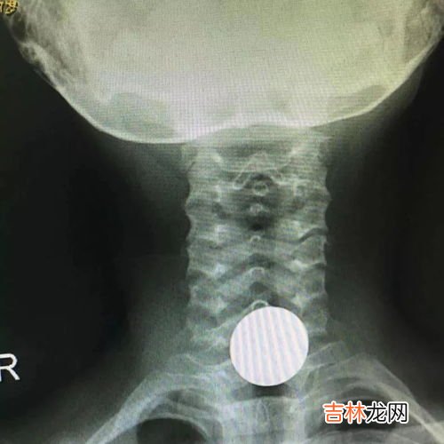 钥匙孔被异物堵住怎么办,钥匙孔被断掉的钥匙堵住了怎么能弄出来？