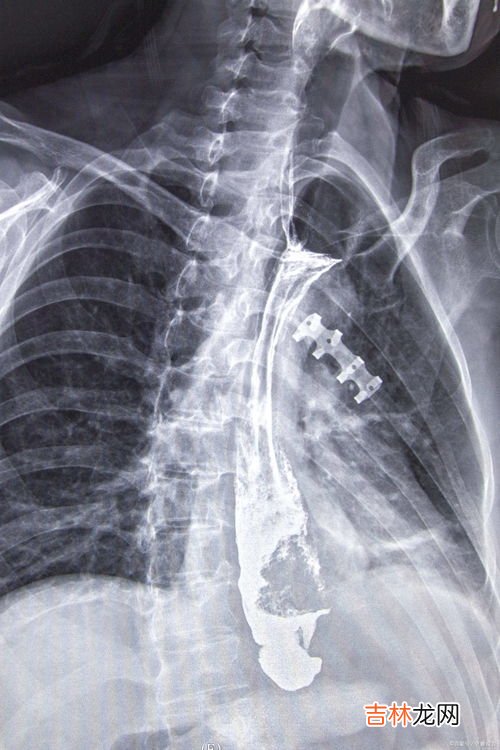 预防食道癌从生活的点滴做起,怎样有效公预防食道癌