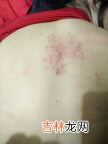 后背长痘痘是什么原因，怎样去除后背痘痘,背上长痘痘怎么消除