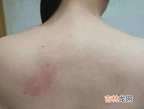 后背长痘痘是什么原因，怎样去除后背痘痘,背上长痘痘怎么消除