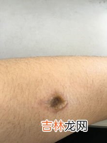 皮肤被晒伤怎样处理,被晒伤的皮肤怎么处理