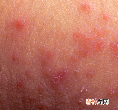 如何调理过敏体质效果好,过敏性体质的人,哪些方法可以改善体质?