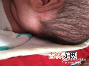 宝宝退烧后全身起红点是怎么回事,宝宝吃了退烧药后，身上出现许多小红点要不要紧