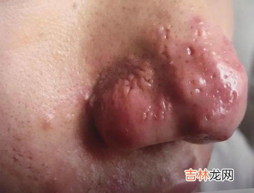 如何把痘痘彻底治好,如何去痘痘最快方法