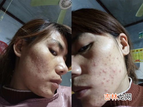 如何把痘痘彻底治好,如何去痘痘最快方法