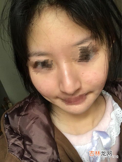 如何把痘痘彻底治好,如何去痘痘最快方法