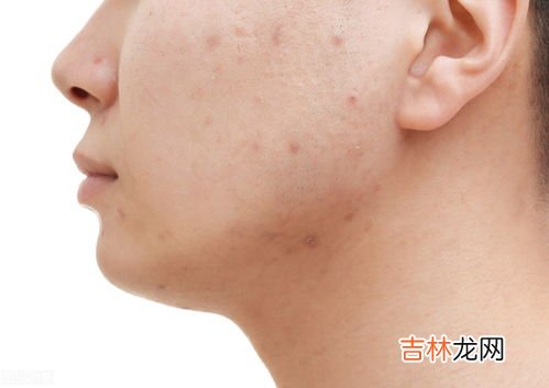 祛除痘痘最简单的方法,怎么去痘痘最快最有效?
