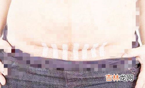 剖腹产对女人身体有多伤害,剖腹产对宝妈身体伤害有多大?具体表现在哪些方面呢?