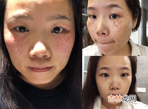 脸上的黑斑用激光祛除能好吗,激光祛斑的方法好吗?