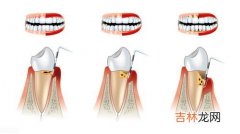 牙齿出血是什么个状况,牙齿出血是什么原因所导致