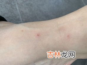 被八角丁咬了怎么办,急急急急急急急急急急急~~~我家的小狗狗被枣树上的八角蛰着了，叫不停，怎么办，心疼死了！