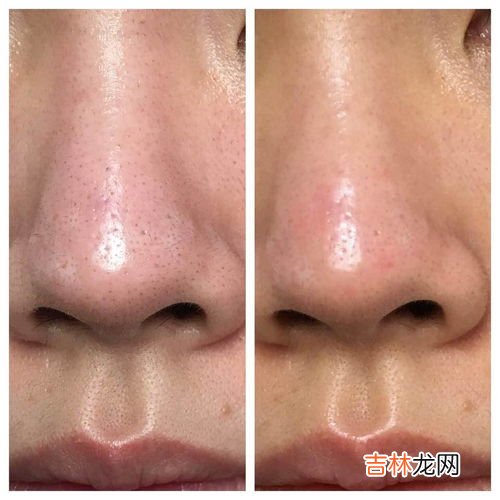 如何处理鼻子上的黑头,鼻头有黑头怎么去除最有效的方法