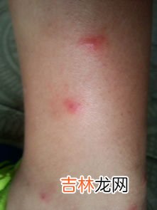 被跳蚤咬了怎么办,被跳蚤咬了怎么处理
