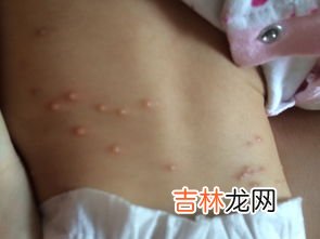 被跳蚤咬了怎么办,被跳蚤咬了怎么处理