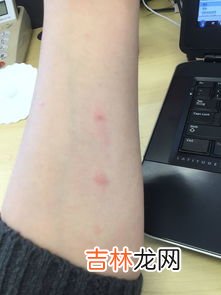 身上总是莫名发痒怎么办,身体皮肤痒怎么治