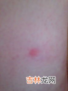 身上总是莫名发痒怎么办,身体皮肤痒怎么治