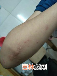 身上总是莫名发痒怎么办,身体皮肤痒怎么治