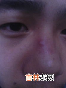 鼻子里面长脓包是什么原因,鼻子周围老长脓包怎么回事? 怎么办?