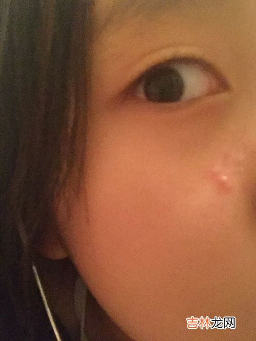 鼻子里面长脓包是什么原因,鼻子周围老长脓包怎么回事？ 怎么办？