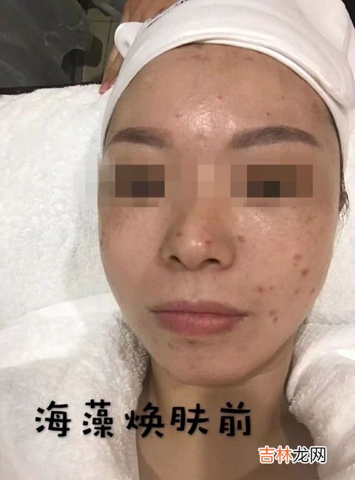 怎么治疗脸上的痤疮,怎么治疗脸上的痤疮