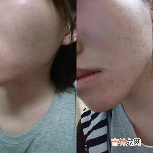 怎么治疗脸上的痤疮,怎么治疗脸上的痤疮