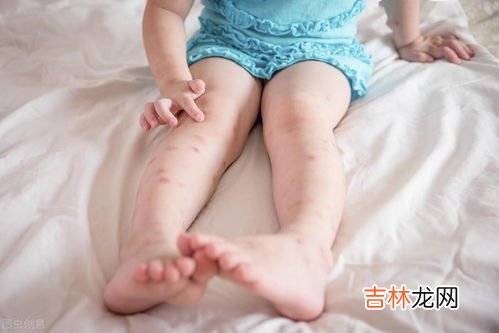 被蚊子咬后怎么快速止痒,被蚊子咬怎么快速止痒
