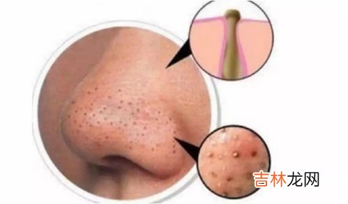 去除黑头小妙招,黑头怎么去除最有效