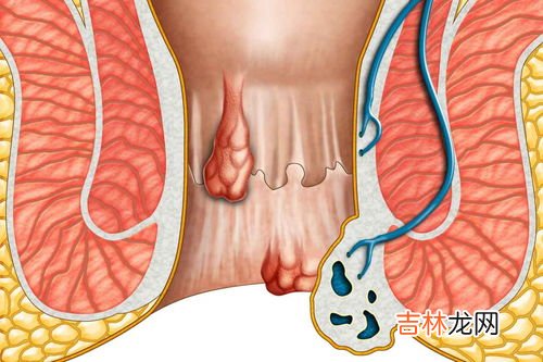 痔疮的症状,痔疮有哪些症状