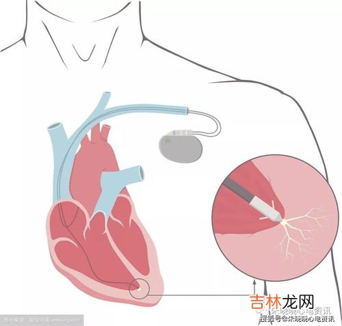 心脏起搏器医保报销吗,2022年浙江省温州市心脏起搏器医保报销吗