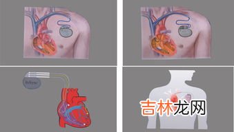 心脏起搏器医保报销吗,2022年浙江省温州市心脏起搏器医保报销吗