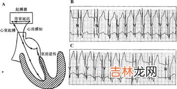 心脏起搏器医保报销吗,2022年浙江省温州市心脏起搏器医保报销吗