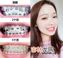 带牙套怎么刷牙,戴牙套后应该如何护理？