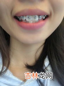 带牙套怎么刷牙,戴牙套后应该如何护理？