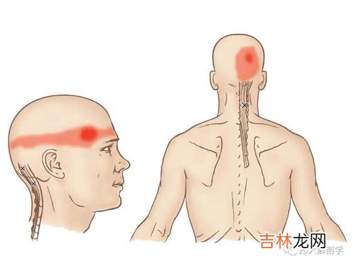 后脑勺疼怎么快速缓解,后脑勺疼怎么办