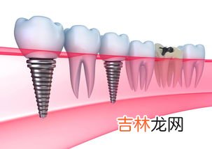 种植牙品牌排行榜,医保种植牙14个主流品牌