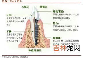 种植牙品牌排行榜,医保种植牙14个主流品牌