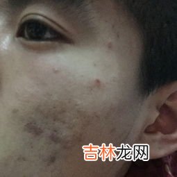 仙草奇虫筋骨贴能根治腰间盘突出不,仙草奇虫筋骨贴的介绍