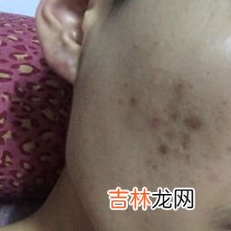 仙草奇虫筋骨贴能根治腰间盘突出不,仙草奇虫筋骨贴的介绍