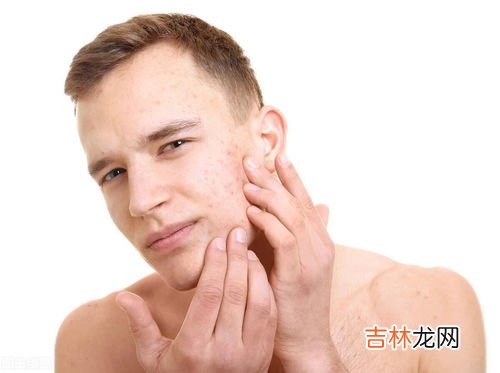 刮胡子刮不干净有黑印怎么去掉,我长有胡子，但刮完后胡子的部位还是黑黑的，请问有什么方法可以淡化胡子部位黑印的吗