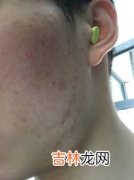 什么皮肤容易长痘痘,毛孔粗大 外油内干 容易长痘痘的肌肤属于什么样的