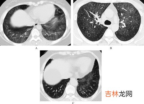 什么是间质性肺炎,间质性肺炎是什么呢,困扰啊!!帮帮忙,想请教一下有经验的人士?