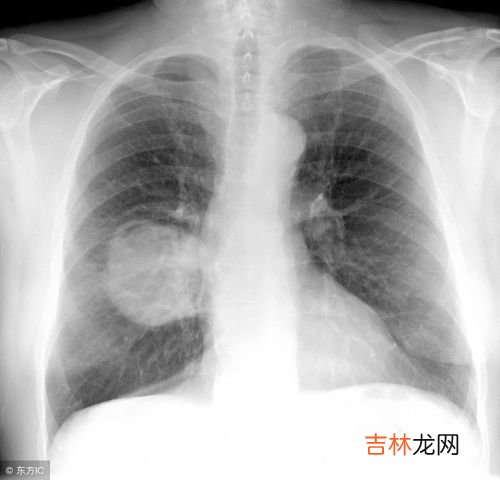 什么是间质性肺炎,间质性肺炎是什么呢,困扰啊!!帮帮忙,想请教一下有经验的人士?